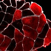 Fluorescent miscroscope image of a right vastus lateralis biopsy from a human patient with COVID-19 pneumonia obtained 0-3 days after ICU admission and labeled with DSHB antibody A4.840 (red). doi.or